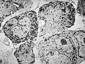 M, 16y. | acidophilic pituitary adenoma (STH) M, 16y. | acidophilic pituitary adenoma (STH)
